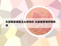 头部银屑病是怎么得来的 头部银屑病早期症状