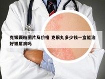 克银颗粒图片及价格 克银丸多少钱一盒能治好银屑病吗