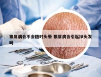 银屑病会不会随时头晕 银屑病会引起掉头发吗