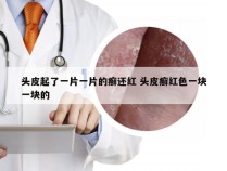 头皮起了一片一片的癣还红 头皮癣红色一块一块的