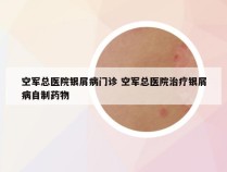 空军总医院银屑病门诊 空军总医院治疗银屑病自制药物