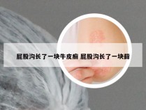 屁股沟长了一块牛皮癣 屁股沟长了一块藓