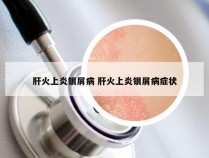 肝火上炎银屑病 肝火上炎银屑病症状