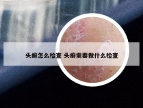 头癣怎么检查 头癣需要做什么检查