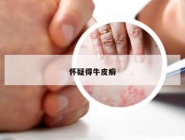 怀疑得牛皮癣