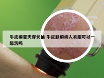 牛皮癣夏天穿长袖 牛皮肤癣病人衣服可以一起洗吗