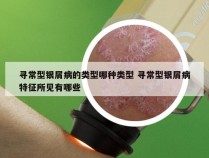 寻常型银屑病的类型哪种类型 寻常型银屑病特征所见有哪些
