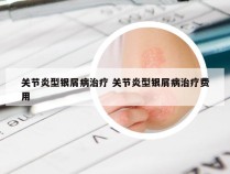 关节炎型银屑病治疗 关节炎型银屑病治疗费用