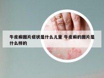 牛皮癣图片症状是什么儿童 牛皮癣的图片是什么样的