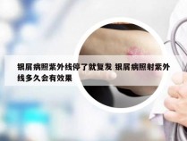银屑病照紫外线停了就复发 银屑病照射紫外线多久会有效果
