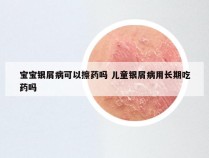 宝宝银屑病可以擦药吗 儿童银屑病用长期吃药吗