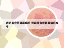 运动员会得银屑病吗 运动员会得银屑病吗知乎
