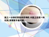 腿上一小块红斑是银屑病吗 大腿上出现一块红斑,有银屑不痛不痒