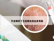 牛皮癣好了之后晒太阳全身发麻
