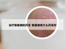 治疗银翘病的药膏 银翘病用什么药膏好