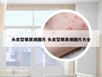 头皮型银屑病图片 头皮型银屑病图片大全