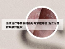 浙江治疗牛皮癣的最好专家在哪里 浙江治皮肤病最好医院