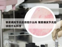 银屑病关节炎应该挂什么科 银屑病关节炎应该挂什么科室