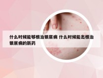 什么时候能够根治银屑病 什么时候能出根治银屑病的新药