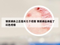 银屑病身上总是长几个疙瘩 银屑病全身起了红色疙瘩