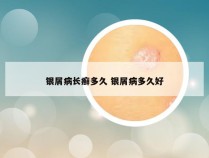 银屑病长癣多久 银屑病多久好