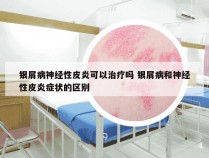 银屑病神经性皮炎可以治疗吗 银屑病和神经性皮炎症状的区别