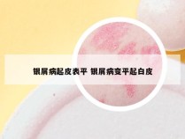 银屑病起皮表平 银屑病变平起白皮