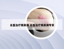 名医治疗银屑病 名医治疗银屑病专家