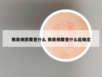 银屑病需要查什么 银屑病要查什么能确定