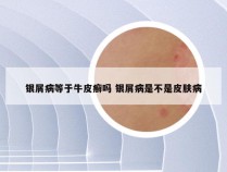 银屑病等于牛皮癣吗 银屑病是不是皮肤病