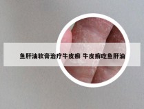 鱼肝油软膏治疗牛皮癣 牛皮癣吃鱼肝油