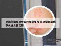点滴型银屑病什么时候会复发 点滴型银屑病多久进入稳定期