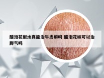 醋泡花椒水真能治牛皮癣吗 醋泡花椒可以治脚气吗