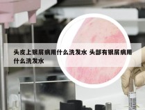 头皮上银屑病用什么洗发水 头部有银屑病用什么洗发水