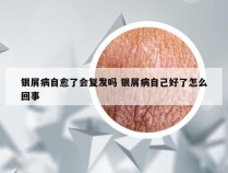 银屑病自愈了会复发吗 银屑病自己好了怎么回事