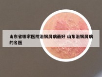 山东省哪家医院治银屑病最好 山东治银屑病的名医
