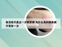 有没有只患过一次银屑病 为什么有的银屑病只发生一次