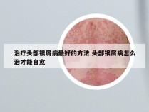 治疗头部银屑病最好的方法 头部银屑病怎么治才能自愈