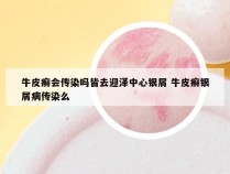 牛皮癣会传染吗皆去迎泽中心银屑 牛皮癣银屑病传染么