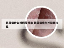 银屑病什么时候能根治 银屑病啥时才能被攻克