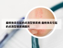 扁桃体炎引起的点滴型银屑病 扁桃体炎引起的点滴型银屑病图片