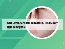 阿维a胶囊治疗银屑病效果好吗 阿维a治疗银屑病专家共识