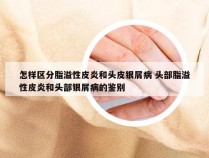 怎样区分脂溢性皮炎和头皮银屑病 头部脂溢性皮炎和头部银屑病的鉴别