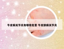 牛皮癣关节炎有哪些危害 牛皮肤癣关节炎