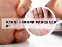 牛皮癣吃什么食物好得快 牛皮癣吃什么比较好?