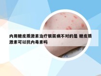 内用糖皮质激素治疗银屑病不对的是 糖皮质激素可以抗内毒素吗