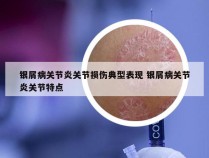 银屑病关节炎关节损伤典型表现 银屑病关节炎关节特点