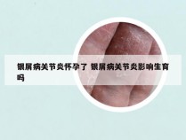 银屑病关节炎怀孕了 银屑病关节炎影响生育吗
