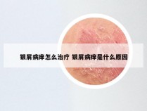 银屑病庠怎么治疗 银屑病痒是什么原因