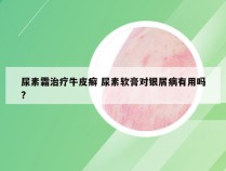 尿素霜治疗牛皮癣 尿素软膏对银屑病有用吗?